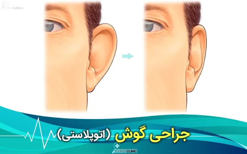 اتوپلاستی چیست