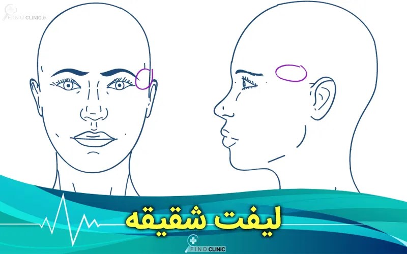 انواع روش های لیفت شقیقه