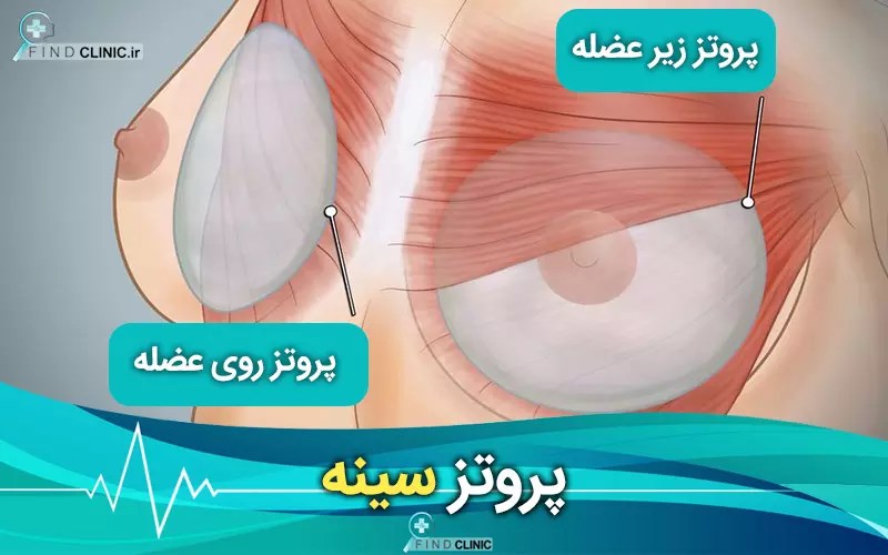ایمپلنت سینه