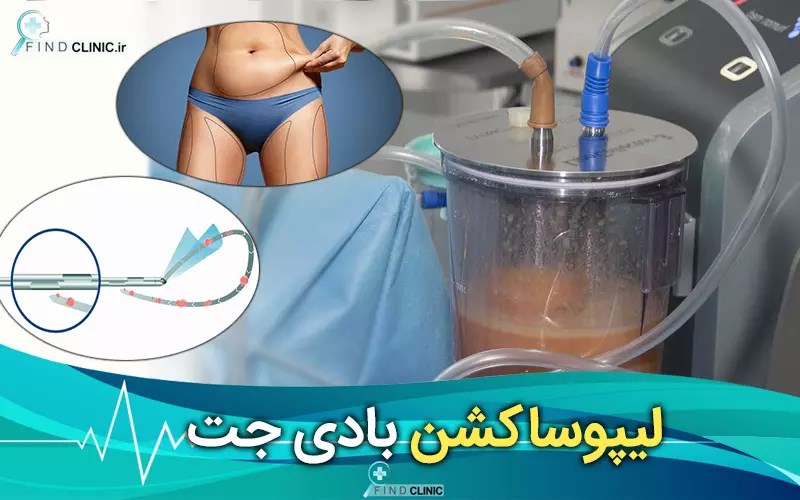 بادی جت شکم پهلو