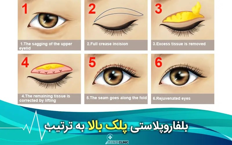 بلفاروپلاستی پلک بالا