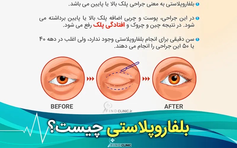 بلفاروپلاستی چیست