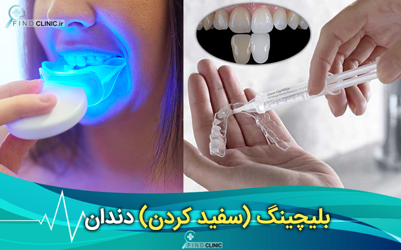 بلیچینگ در خانه