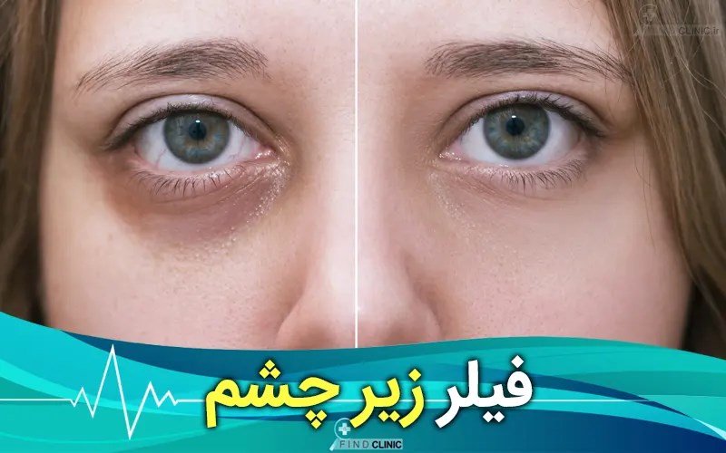 بهترین برند فیلر زیر چشم