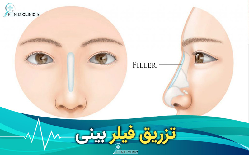 تزریق ژل به بینی