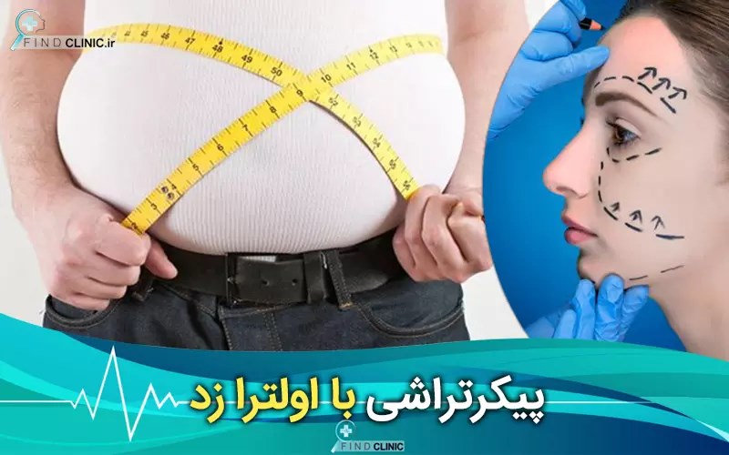 جراحی اولترازد چیست