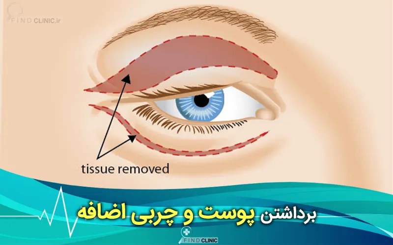 جراحی پلک بالا و پایین