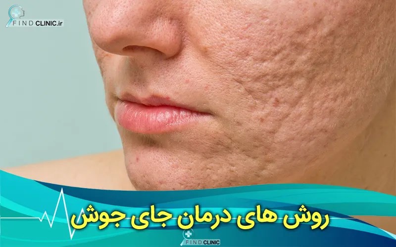 بهترین روش های درمان و از بین بردن جای جوش فایند کلینیک