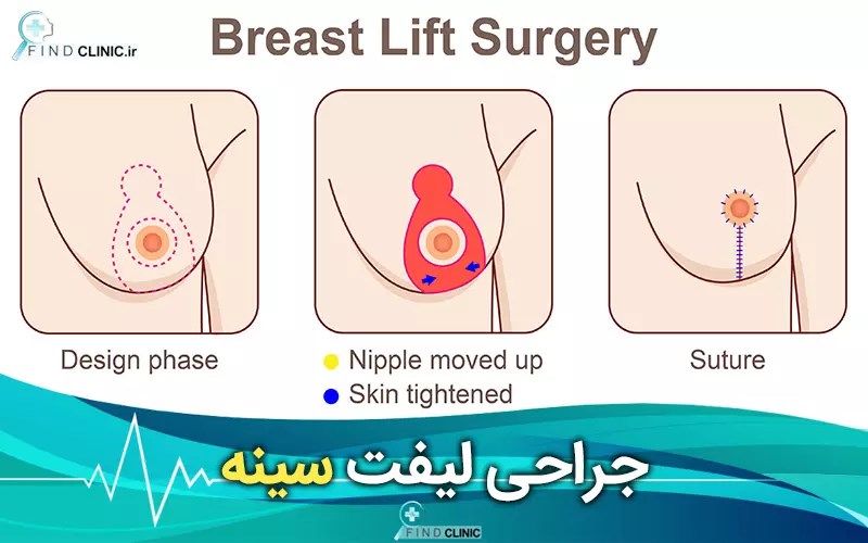 روش های جراحی لیفت سینه