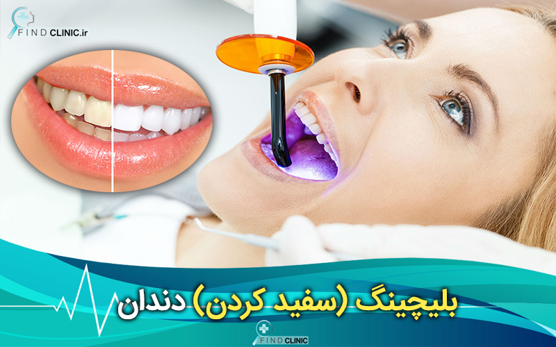 سفید کردن دندان