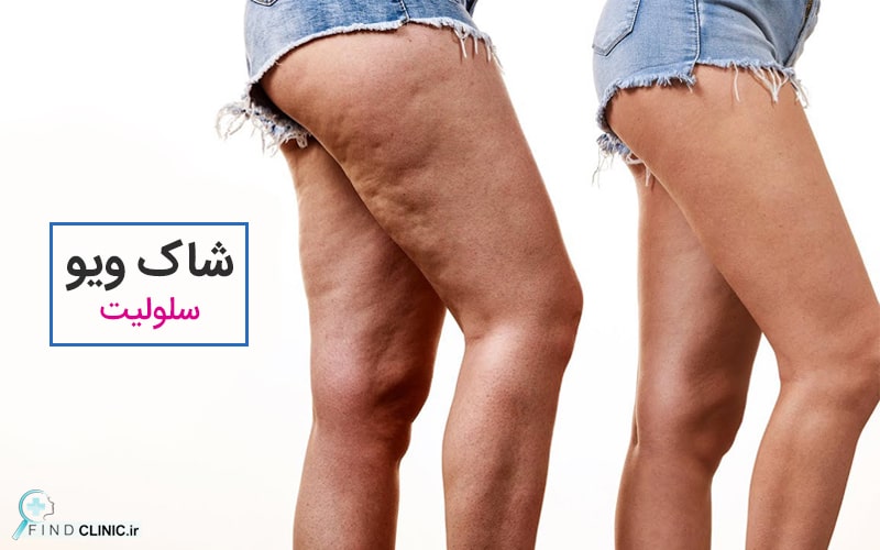 شاک ویو لاغری