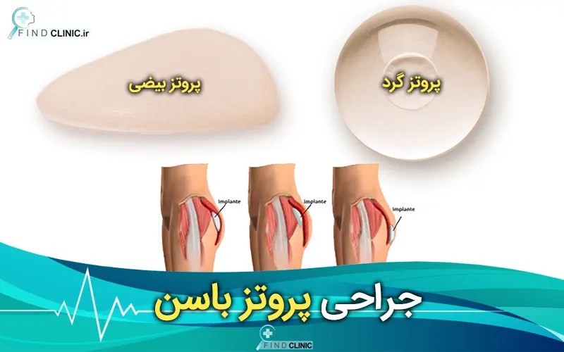 عمل پروتز باسن