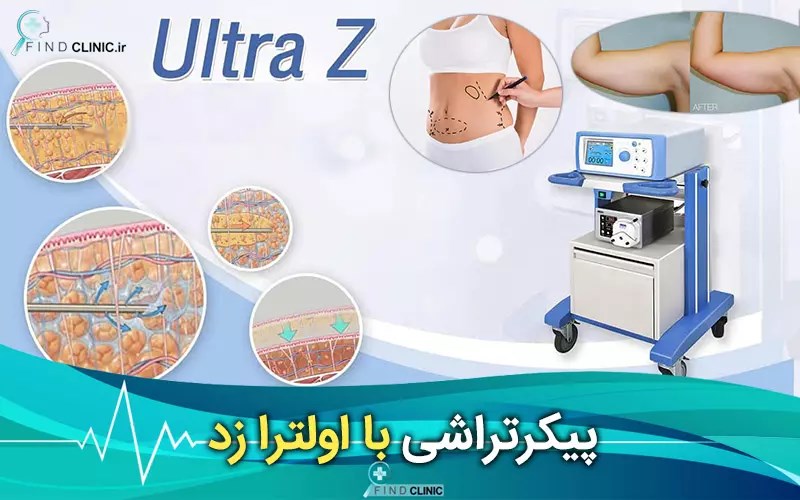 عوارض اولترازد