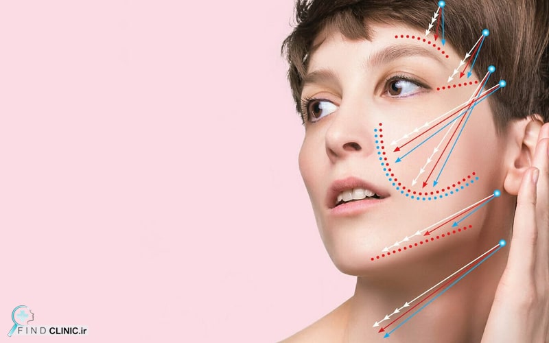 عوارض لیفت با نخ