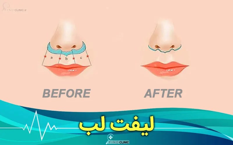 عوارض لیفت سانترال لب