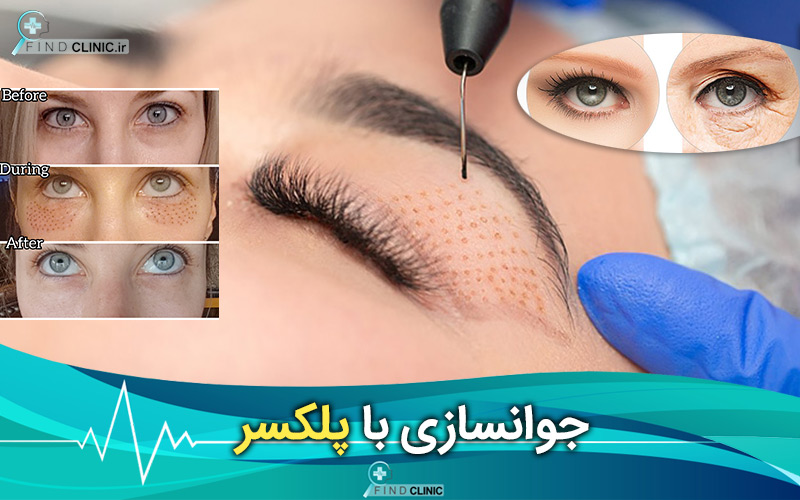 عوارض پلکسر