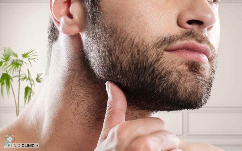 عوارض کاشت ریش