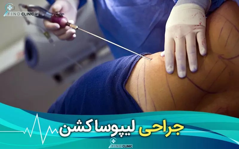 عکس از عمل لیپوساکشن