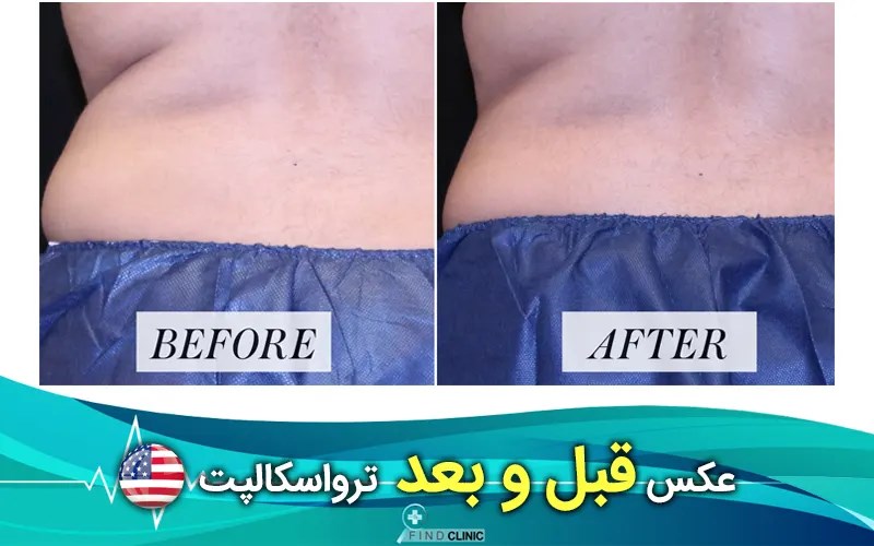 عکس ترواسکالپ