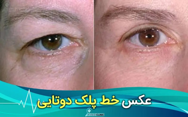 عکس خط پلک دوتایی