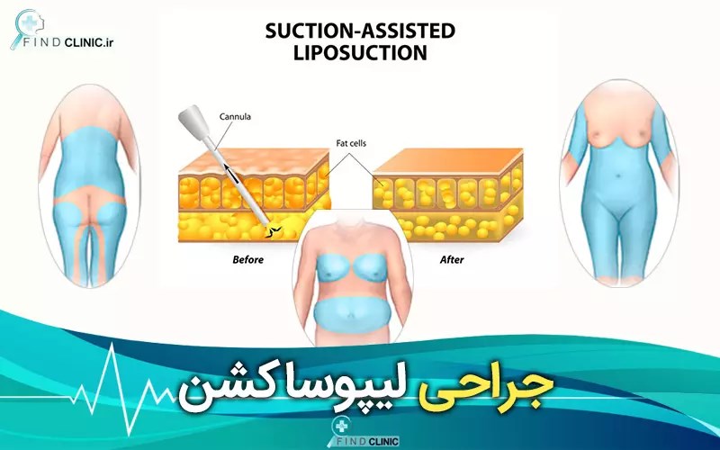عکس عمل لیپوساکشن