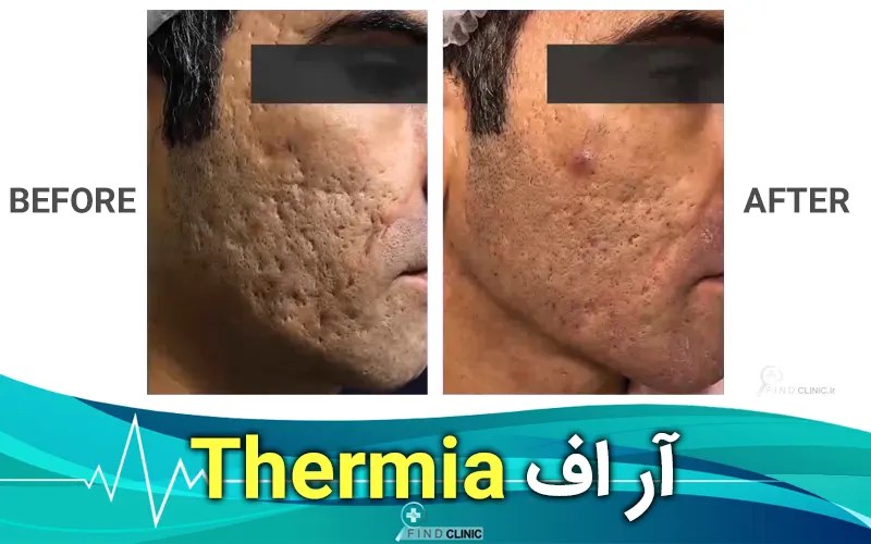 عکس قبل و بعد از ترمیا جای جوش