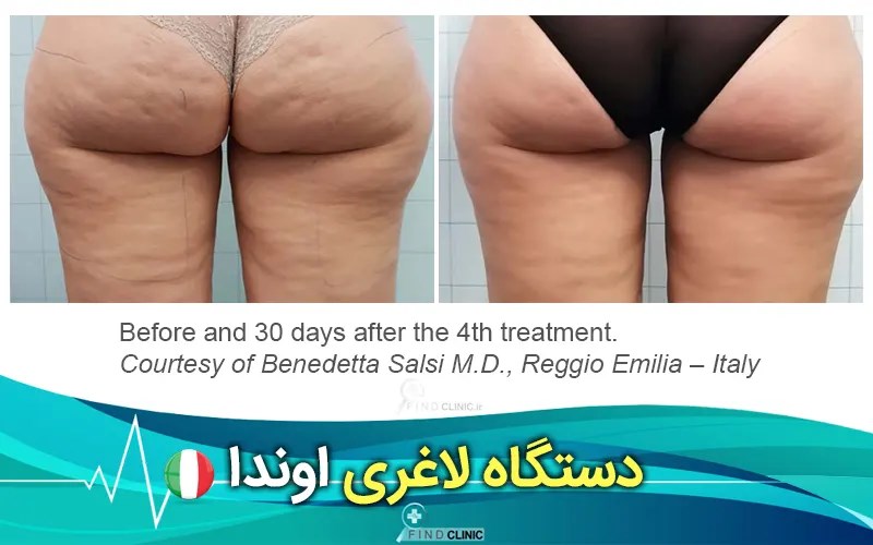 عکس قبل و بعد اوندا