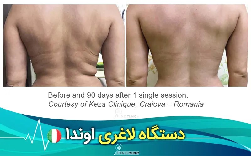 عکس قبل و بعد دستگاه لاغری اوندا