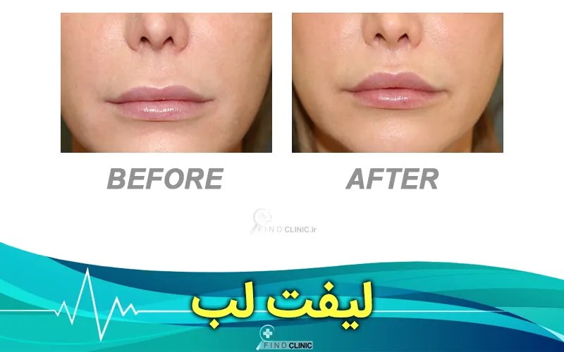 عکس قبل و بعد لیفت سانترال لب
