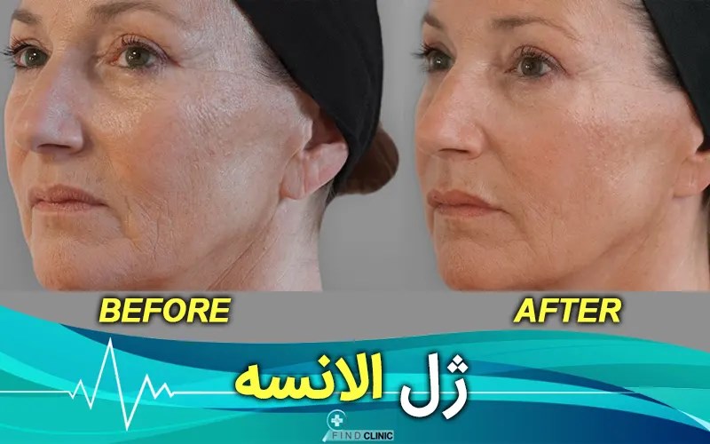 عکس قبل و بعد ژل الانسه