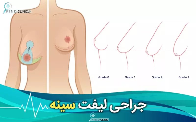 عکس لیفت سینه