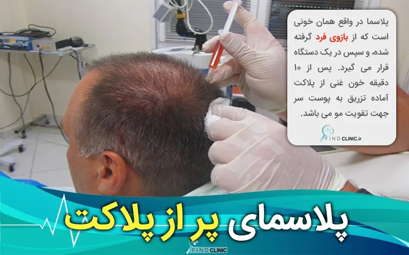 عکس پی آر پی مو