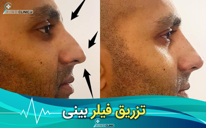 قبل و بعد تزریق فیلر بینی