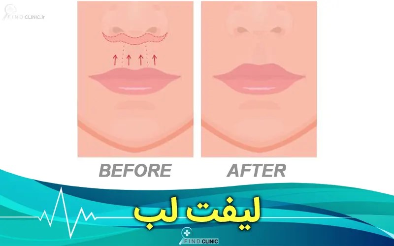 قیمت لیفت سانترال لب