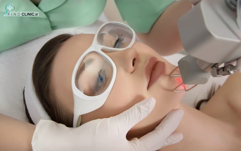 لیزر co2 فرکشنال