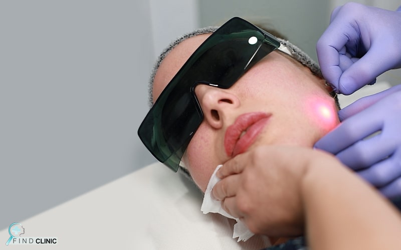 لیزر اندولیفت صورت