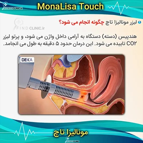 لیزر مونالیزا تاچ چگونه انجام می شود