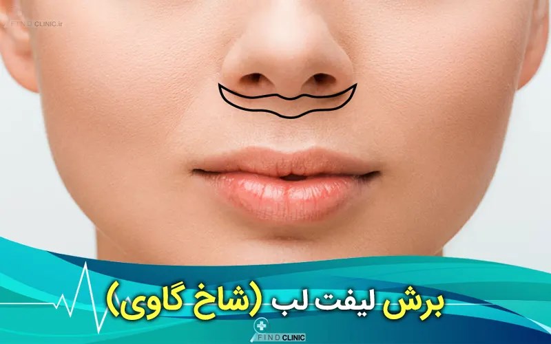 لیفت سانترال لب چگونه انجام می شود