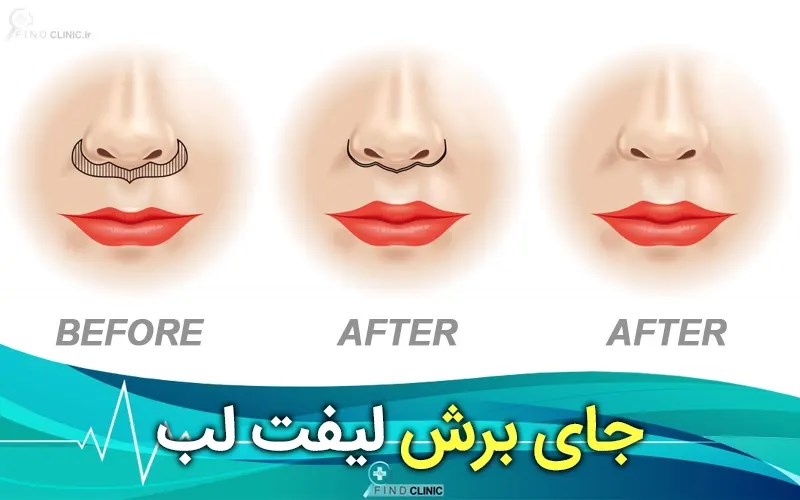 لیفت سانترال لب چیست