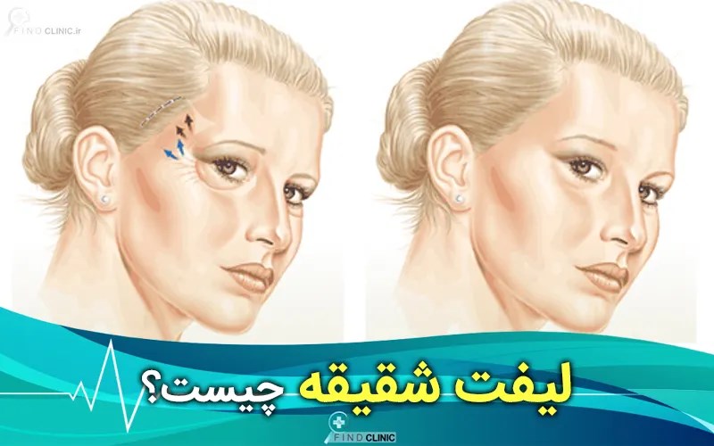 لیفت شقیقه چیست