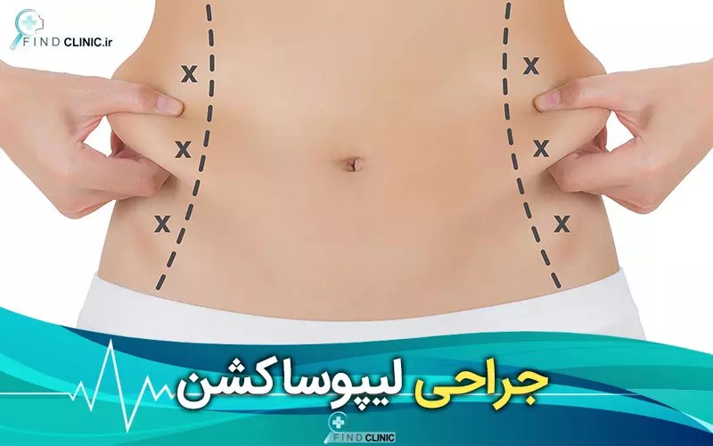لیپوساکشن شکم