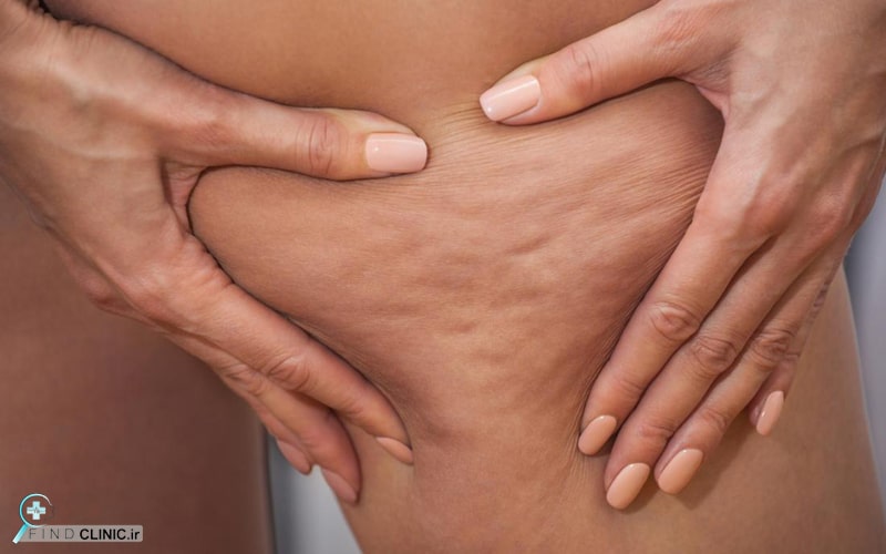 مراقبتهای بعد از شاک ویو لاغری