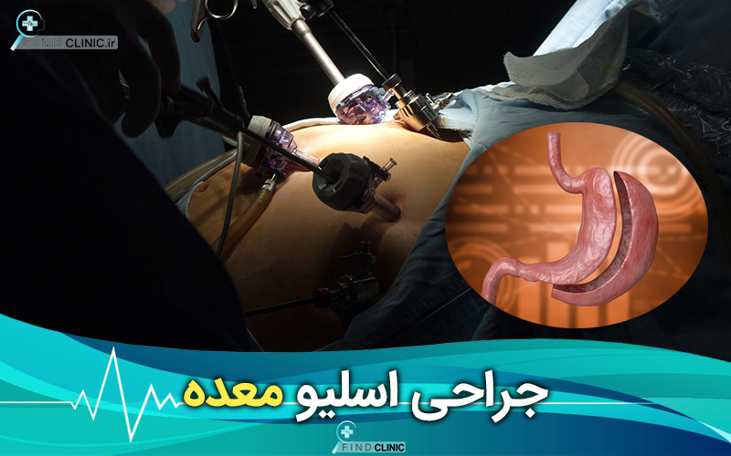 معایب اسلیو معده