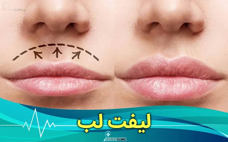 نتایج لیفت سانترال لب