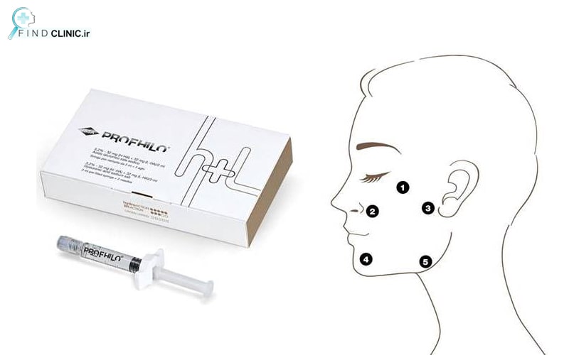 نقاط تزریق ژل پروفایلو
