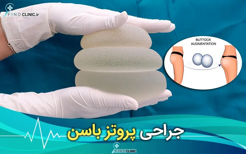 پروتز باسن چیست