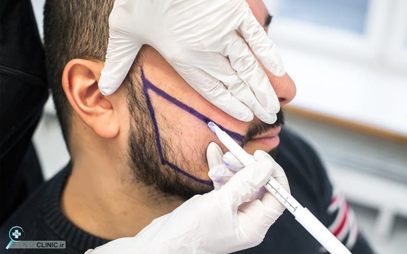 کاشت ریش به روش sut