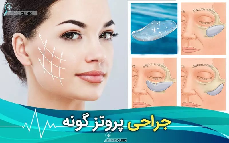 کاشت گونه با پروتز