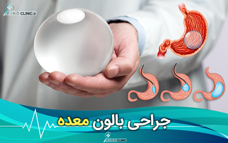 کی بالون معده گذاشته